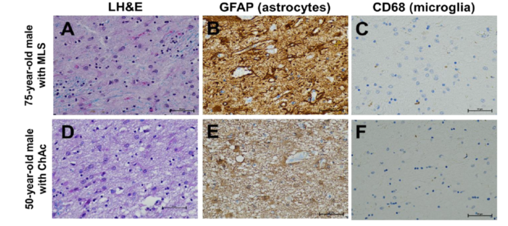 Figure 1. The panels on the left (A, D) show loss of neurons in the caudate nucleus. The middle panels (B,E) show the activation of astrocytes (brown label), in contrast to the absence of microglial activation (C,F).