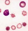 acanthocytes