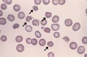 Scientific (microscope) image of blood cells, including acanthocytes 